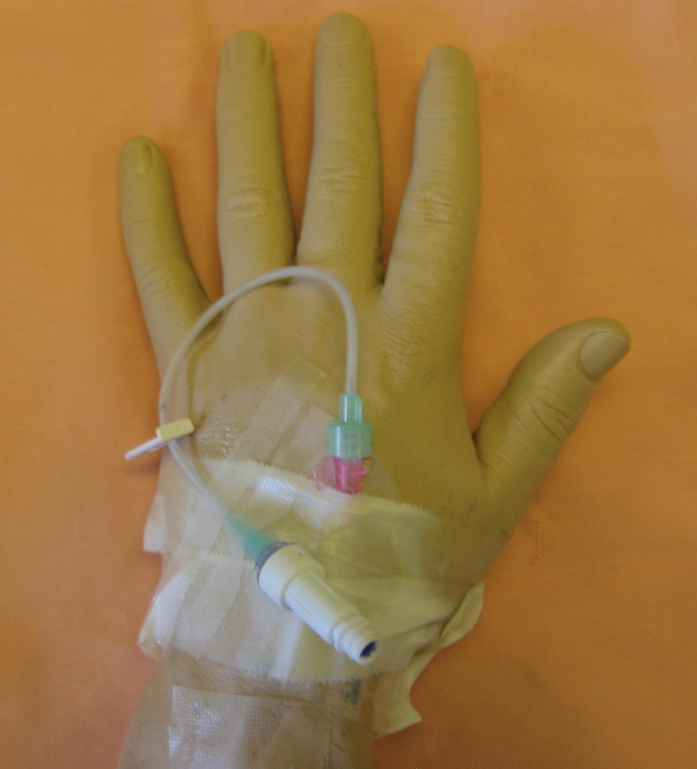 Routine IV or a heparin lock? BabyCenter